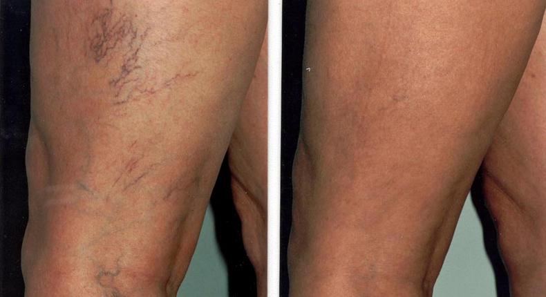 6 simple things spider veins are telling you to do