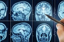 Przełom w badaniach nad glejakiem: naukowcy odkrywają nowe cele terapeutyczne i wskazują potencjalny lek