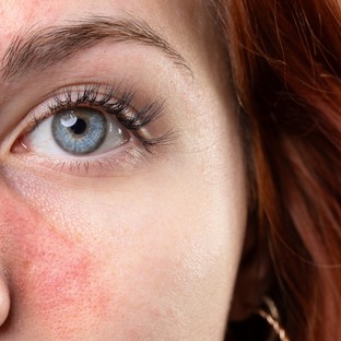 Rosacea, akné: a ChatGPT szinte hibátlanul felismeri a leggyakoribb bőrproblémákat