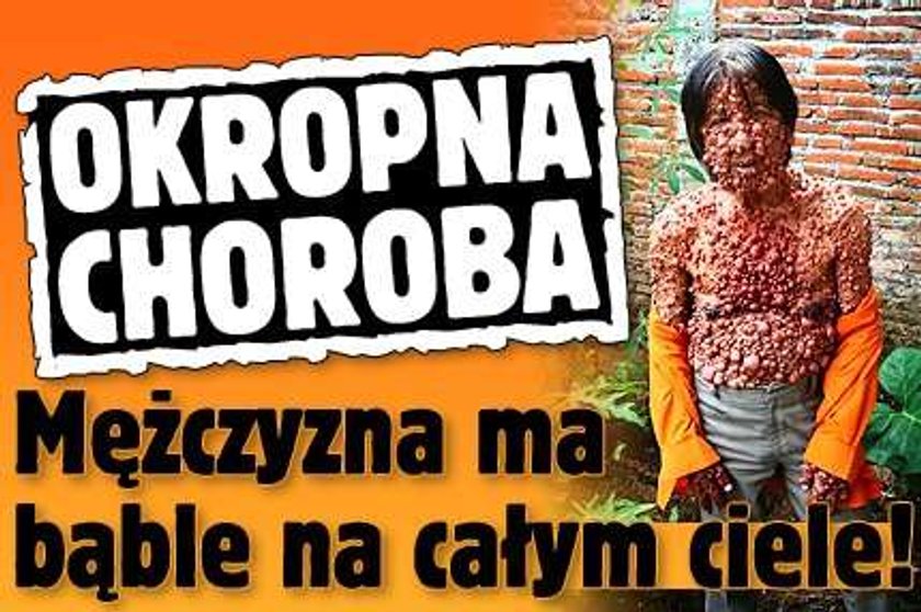 Okropna choroba. Mężczyzna ma bąble na całym ciele!