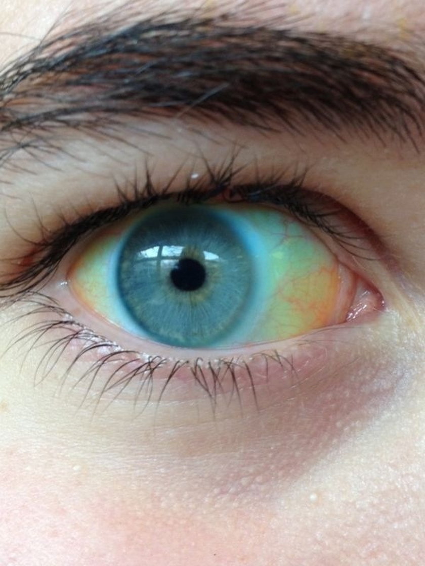 Почему желтым цветом глаз. Пожелтение склер гепатит.