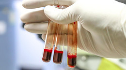 Badanie krwi może ujawnić przerzuty czerniaka