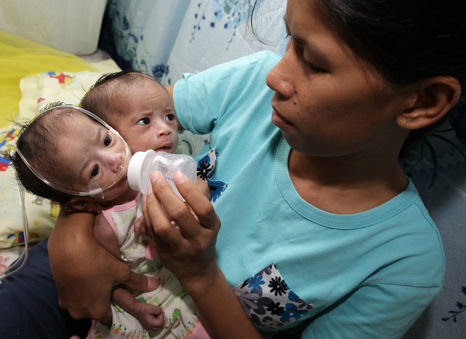 PHILIPPINES CONJOINED TWINS