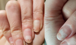 Płytka paznokcia zmienia kolor? To onycholiza, choroba, której sprzyja źle zrobiona hybryda