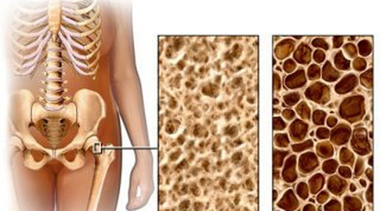 Ezt érdemes tudni a csontritkulásról!