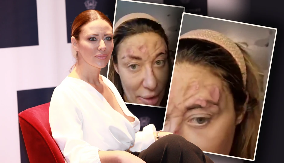 Ana Nikolić sa problemima na licu
