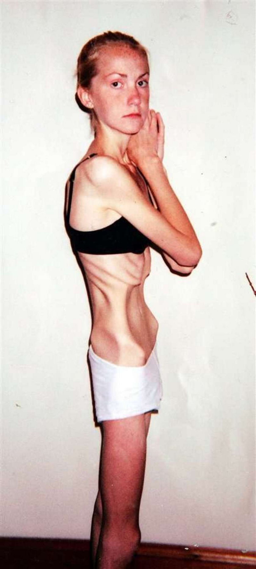 Po 12 latach pokonałam anoreksję