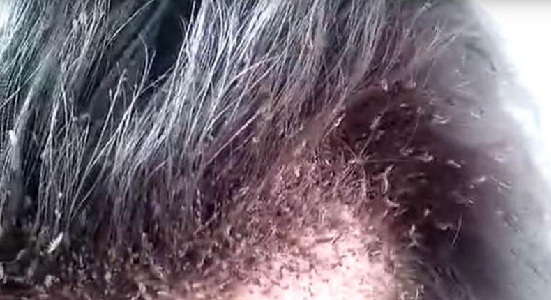 Meet strange man with thousands of Lice on his scalp and hair