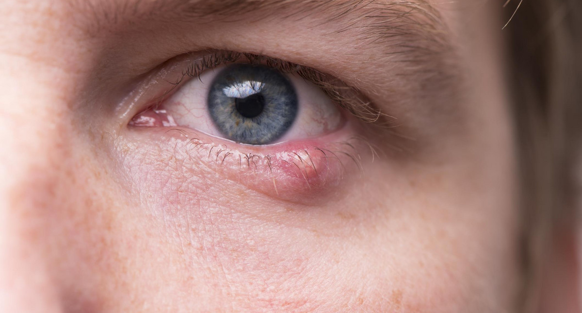 Jęczmień na oku - przyczyny, objawy, leczenie, domowe sposoby