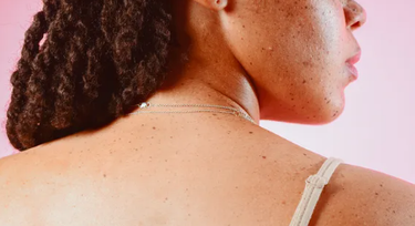 Why skin tags develop and how to remove them