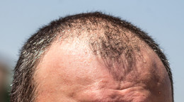 AGA - najczęstszy męski problem. Jak zatrzymać wypadanie włosów?
