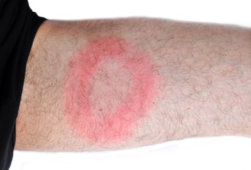 Ígéretes kutatás: hamarosan megelőzhető és kezelhető lesz a Lyme-kór?