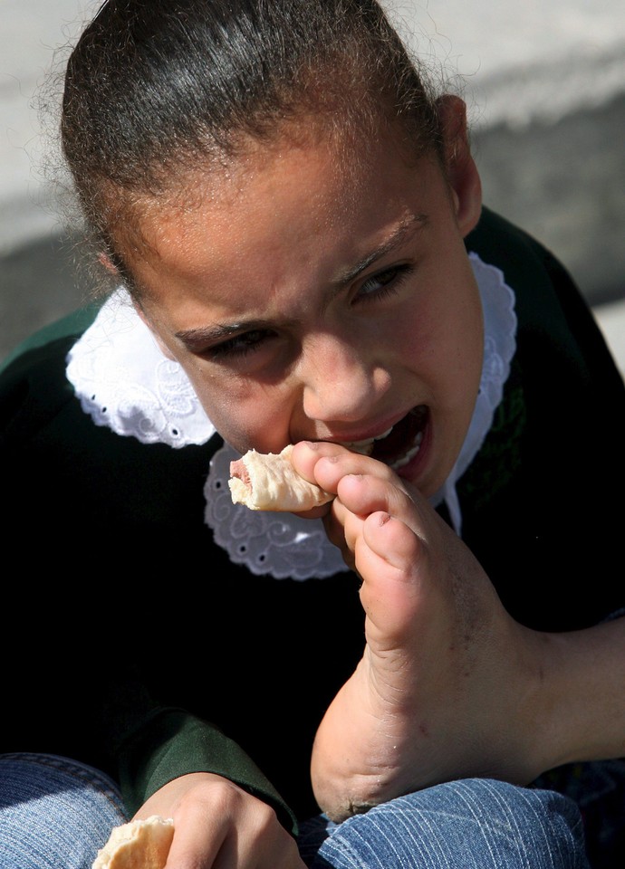 MIDEAST PALESTINIANS GIRL WITHOUT ARMS