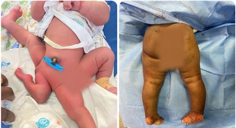 KATH doctors conduct 6-hour successful surgery on 5-month-old baby born with 4 legs