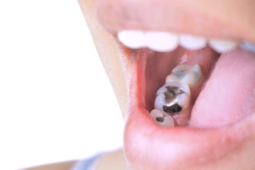 amalgam, fogtömés, higany, fog