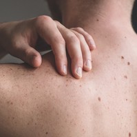 Ha ezeket a tüneteket tapasztalja, irány a bőrgyógyász! Bőrrákot is jelezhetnek