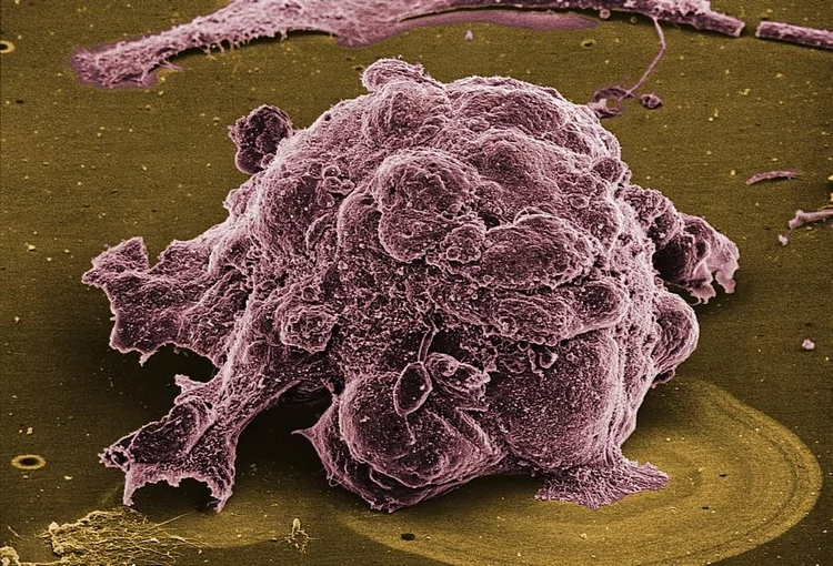 Komórka raka piersi