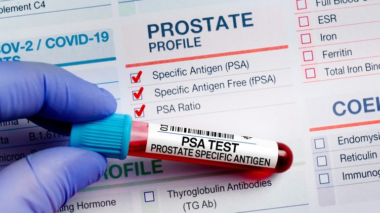proszataszűrés prosztatarák rákszűrés PSA eredménye