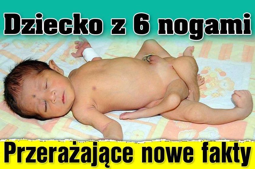 Dziecko z 6 nogami. Przerażające nowe fakty