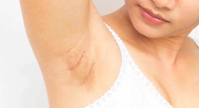 Pimple in Armpit Female: Unveiling the Mystery and Finding Relief!