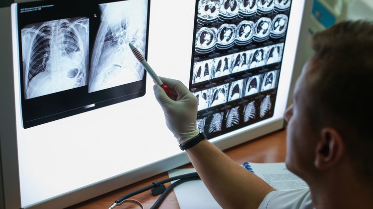 Mi a mellkas CT (Thorax CT) vizsgálat leírás