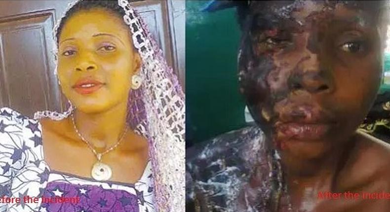 This lady, Aladi Sule was disfigured by her boyfriend because she dumped him