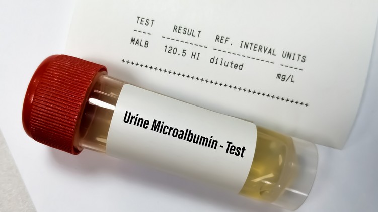 Mit jelent vizelet mikroalbumin érték laborlelet