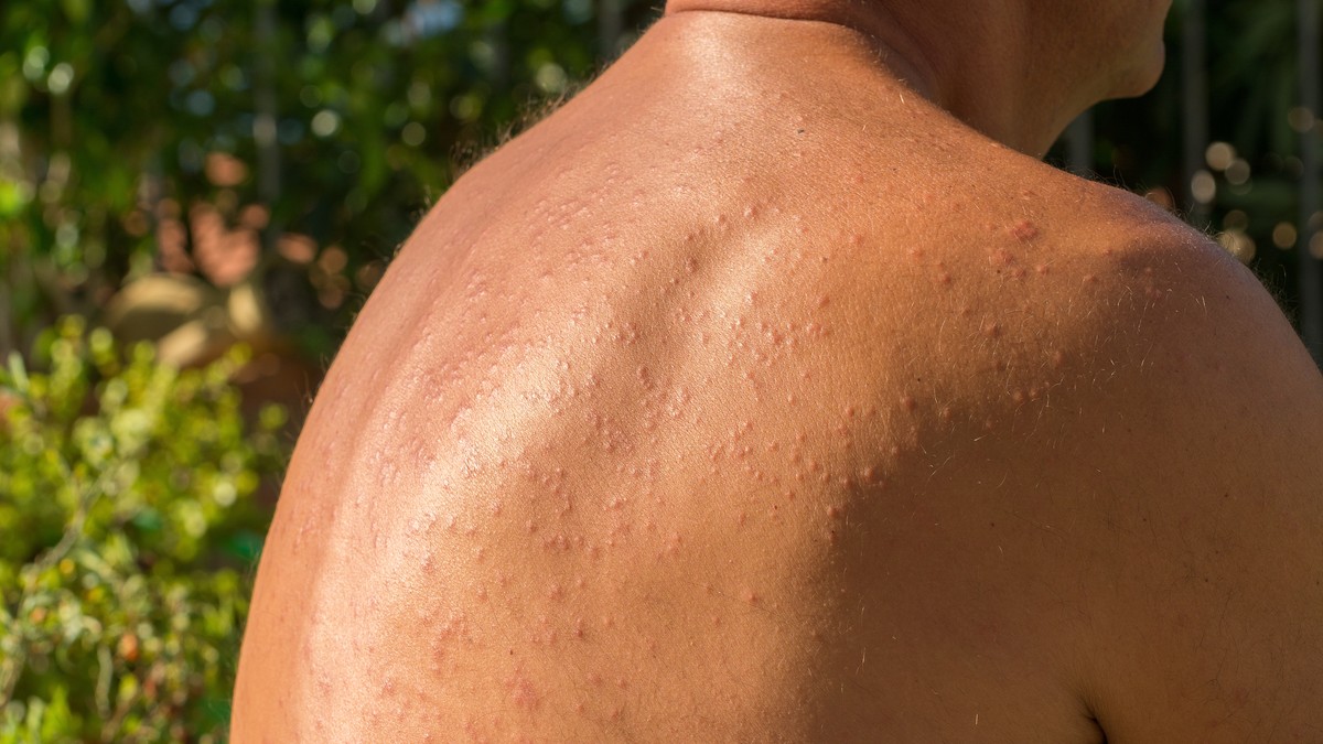 Najčešća alergijska reakcija kože na kremu za sunce je osip.