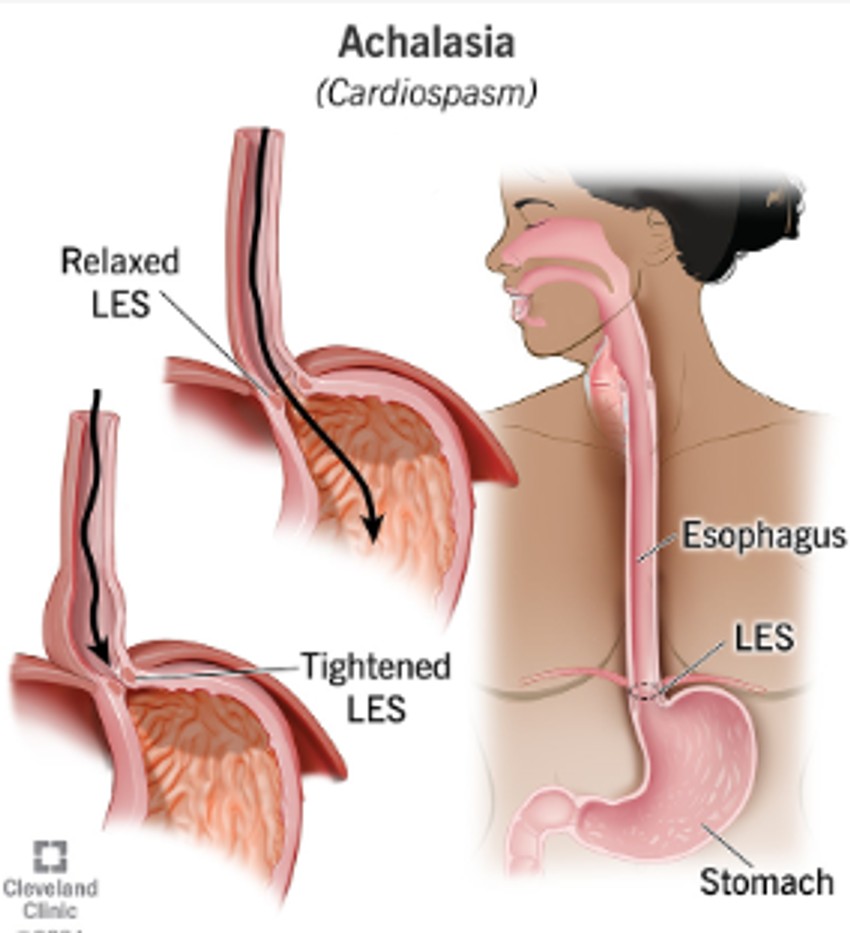 Kod ahalazije, donji ezofagealni sfinkter se ne opušta, zbog čega se hrana i tečnost nagomilavaju u jednjaku