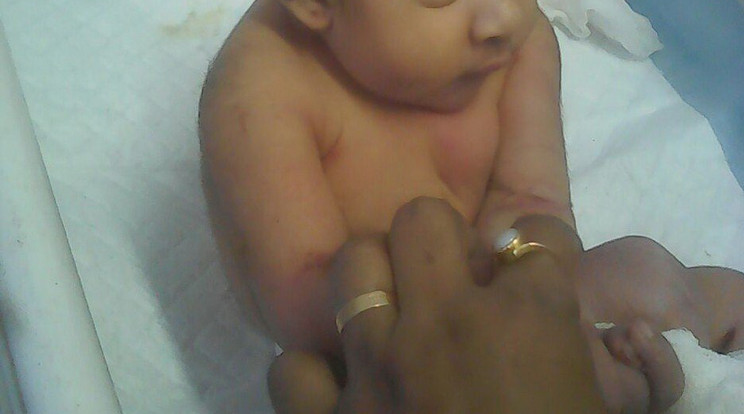 Koponyán kívüli aggyal született baba - Fotó: Profimedia-Reddot