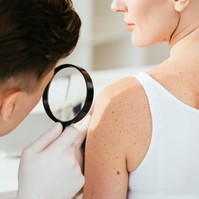 Basalioma, melanoma, spinalioma: ezek a 3 leggyakoribb bőrrák korai tünetei