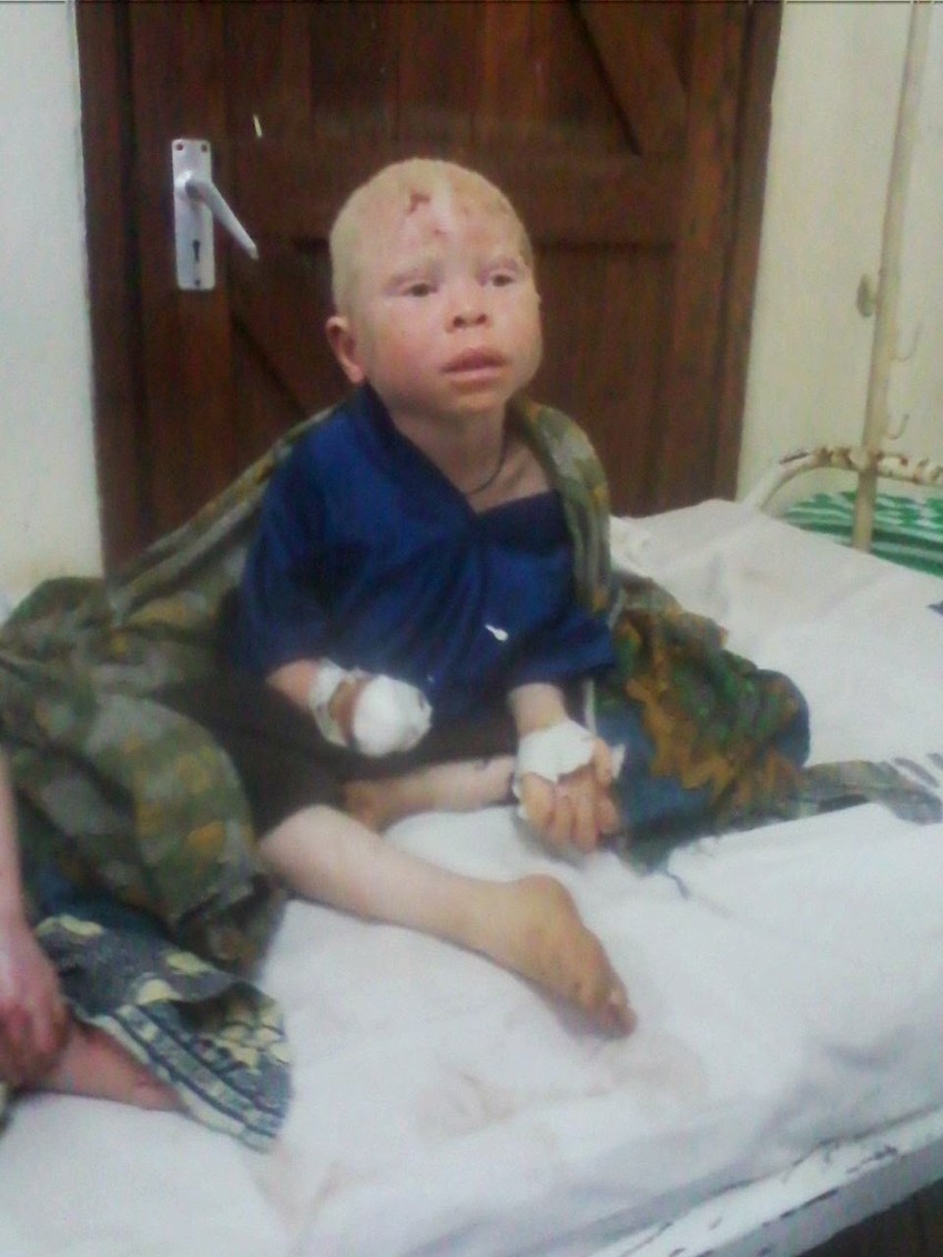 Osakaćeni šestogodišnjak Baraka Kosmas