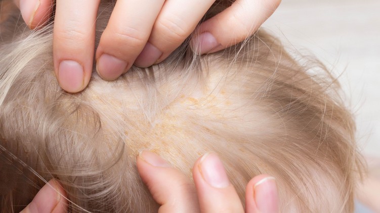 zsíros, sárgás, folt, fejbőr, seborrhoeas dermatitis
