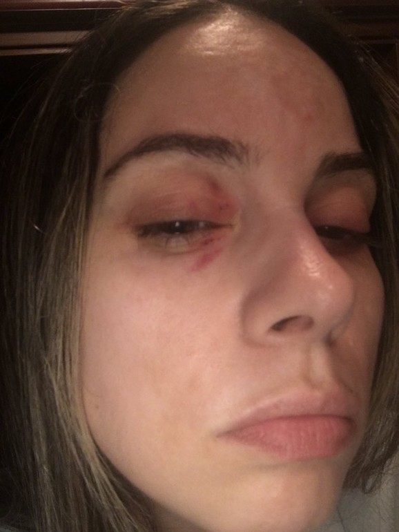 Mina sa povredama oka