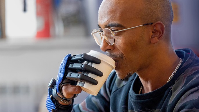 Ali kezét 6 évesen megcsonkította a húsdaráló, most ő lett a világon az első, aki 3D-nyomtatott ujjakat kapott – fotók