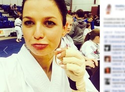 Anna Lewandowska dostała w twarz. Żona piłkarza ma podbite oko i rozciętą wargę. ZDJĘCIA