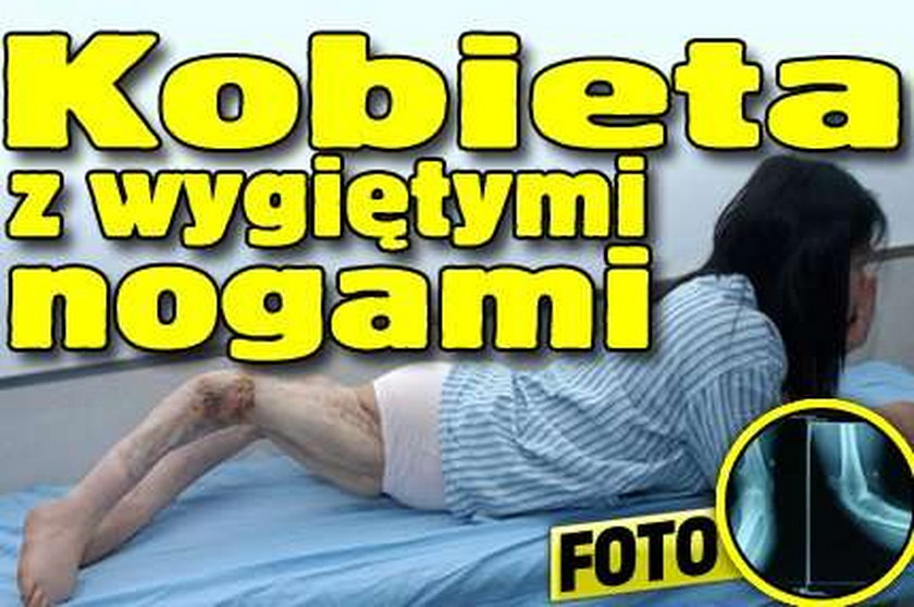 Kobieta z wygiętymi nogami. Foto