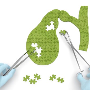 Epekövesség után valóban indokolt az epehólyag eltávolítása? Van kockázata? Az orvos válaszol