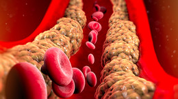 Po cichu sieje spustoszenie w organizmie. Co się dzieje, gdy masz wysoki cholesterol?