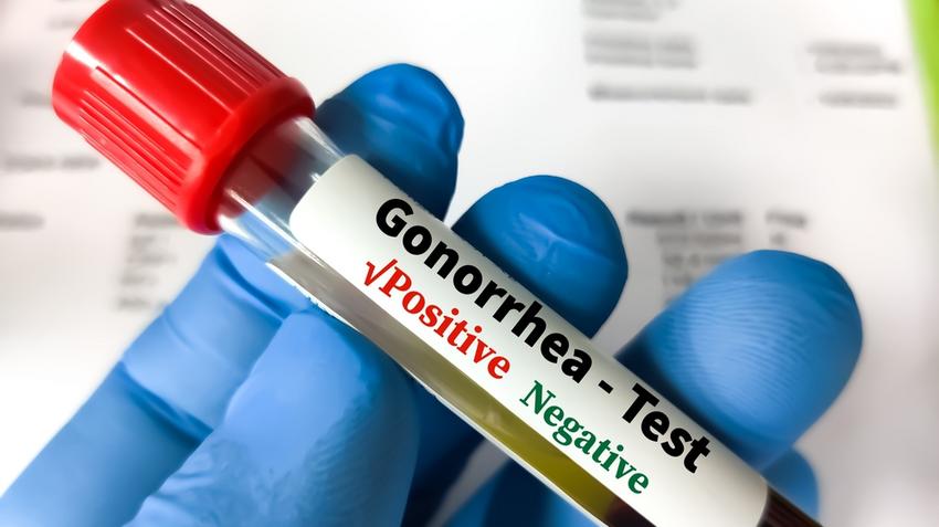 teszt szexuális fertőzés gonorrhoea  chlamydia HPV STD önmmintavétel