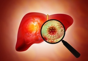 Retko, ali hepatitis A može dovesti do otkazivanja jetre 
