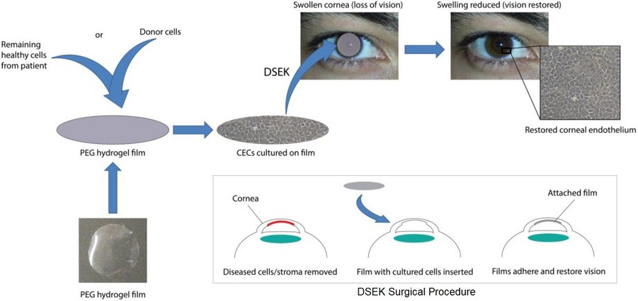 Przebieg operacji z wykorzystaniem hydrożelu i wyhodowanych komórek rogówki