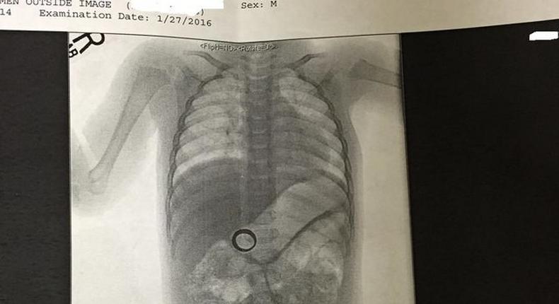 Doctors shocked to find woman's missing wedding ring inside her baby