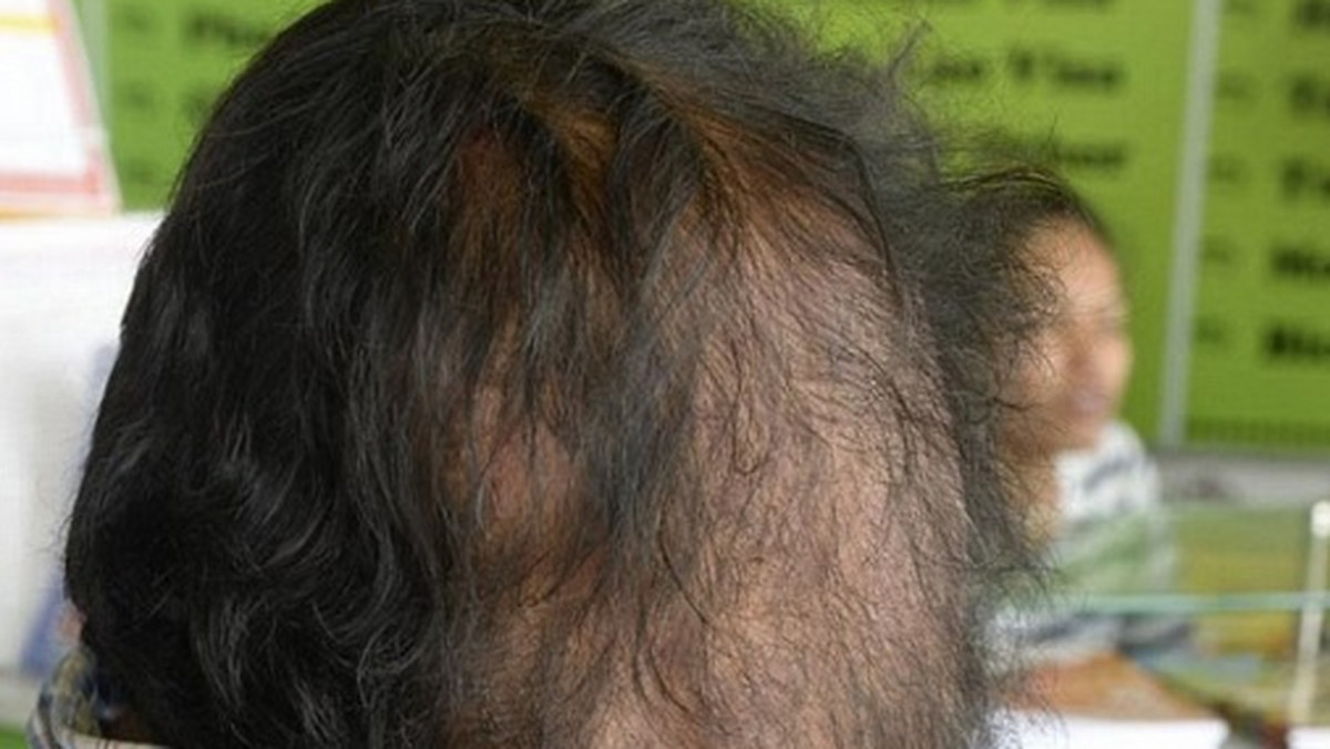 Vid to 34-letni mieszkaniec Kambodży, który urodził się z naroślą na połowie swojej twarzy, która jednocześnie zasłania mu prawe oko. Mężczyznę na ulicy spotkało małżeństwo z Australii, które zaoferowało mu pomoc.