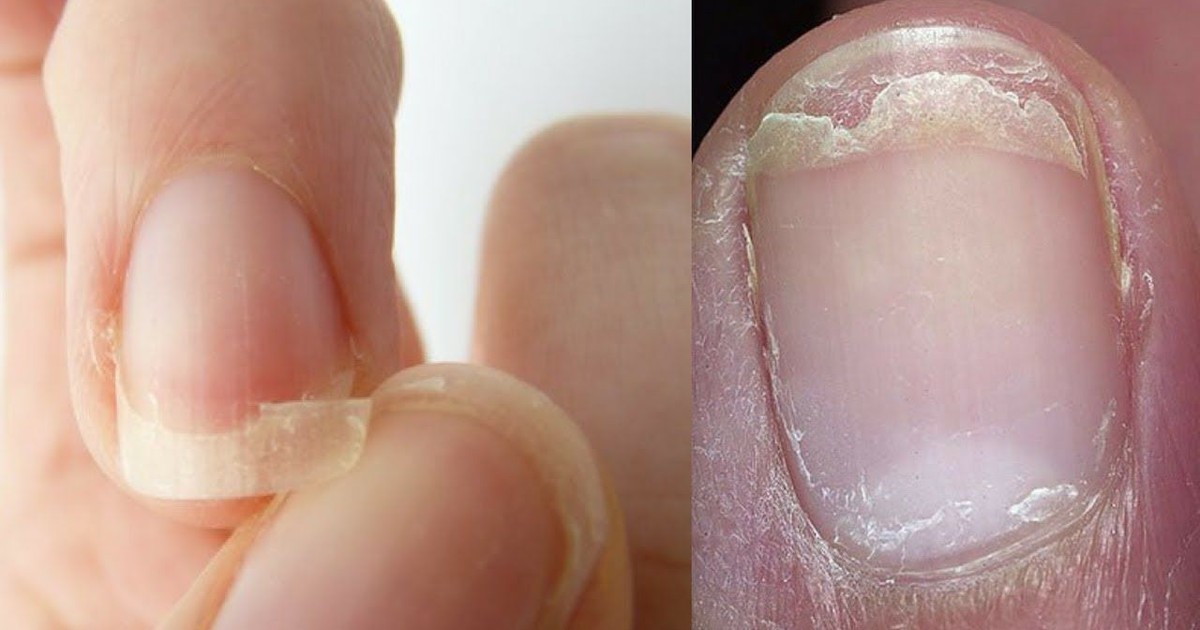 Brittle Nails How you can naturally treat this disorder Pulse Nigeria