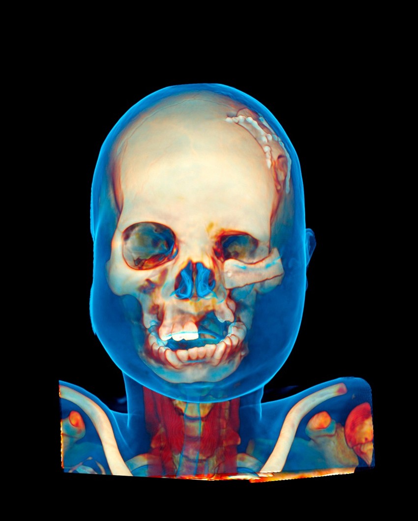 Savremenim metodama rekonstrukcije lica policija je uspela da prikaže izgled žrtve