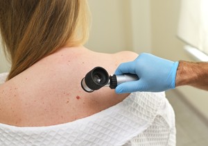 Rak kože je čest ali kada se rano otkrije on je izlečiv