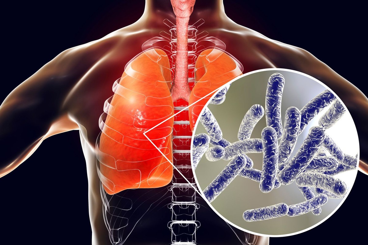 Bakterie Legionella pneumophila w ludzkich płucach