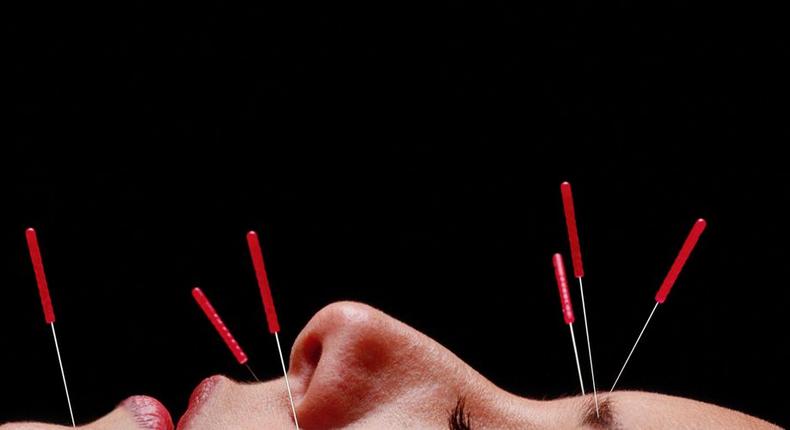 Can Acupuncture Really Help You Lose Weight?