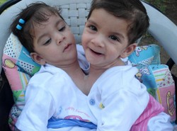 Bliźniaczki syjamskie czekają na operację rozdzielenia